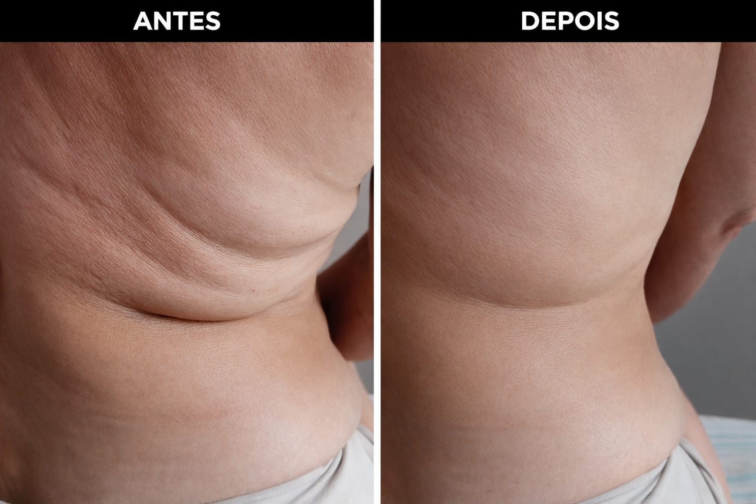 Antes e depois: firmeza e modelagem corporal